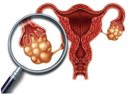 为什么多囊卵巢综合征患者一定要减肥？怎样减肥是有效的呢？